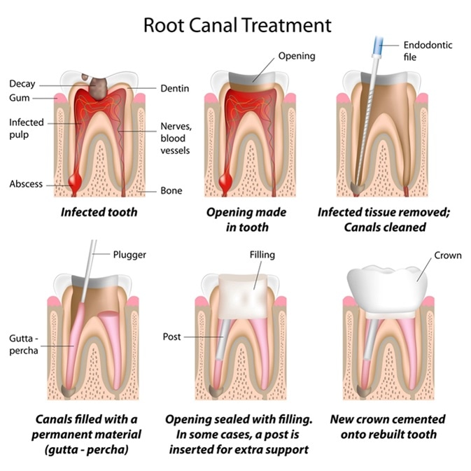 Illustration of a root canal procedure showing the inside of a tooth