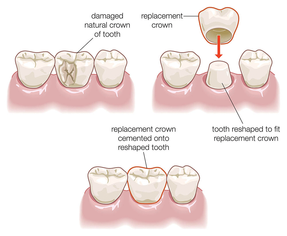 Illustration of a dental crown procedure
