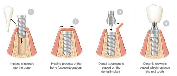 Illustration of the dental implant procedure
