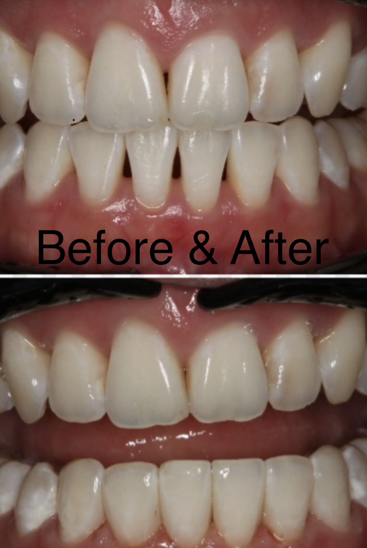 Bioclear before and after — black triangles closed between front teeth