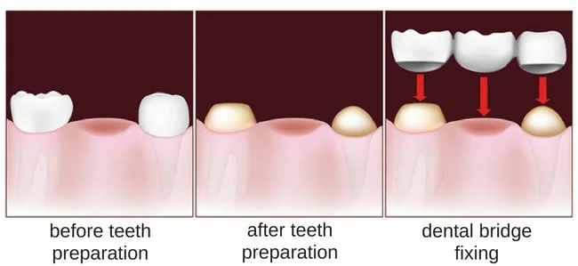 Illustration of the dental bridge procedure steps